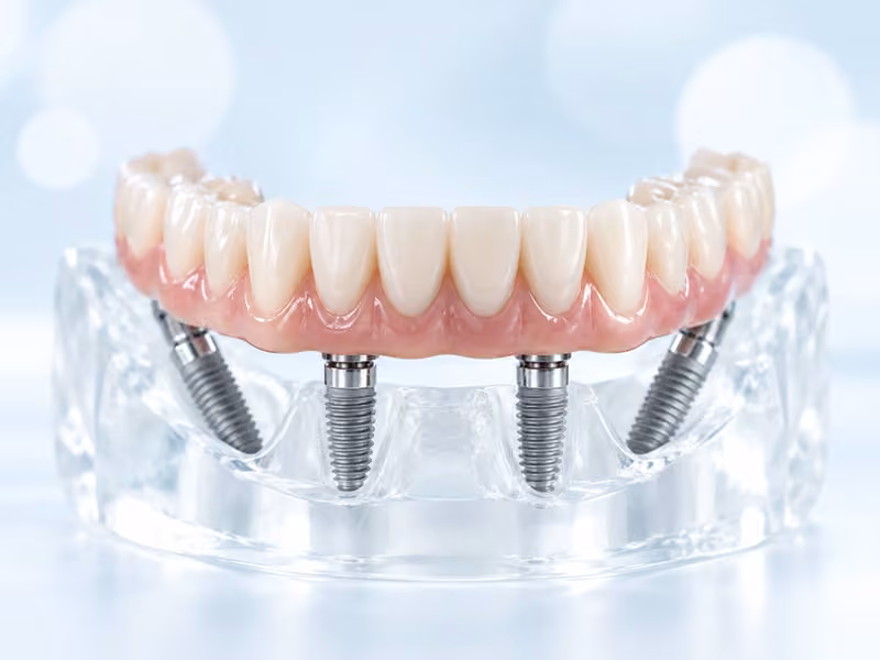 Festsitzender Zahnersatz auf mehreren Implantaten